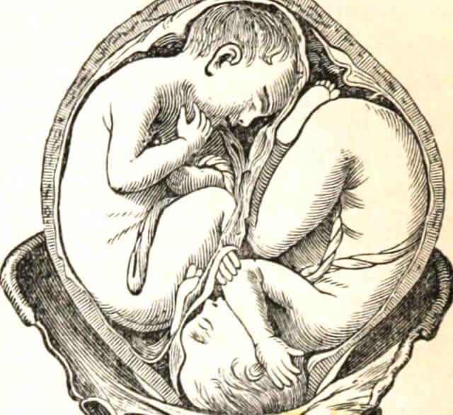 twin_fetuses